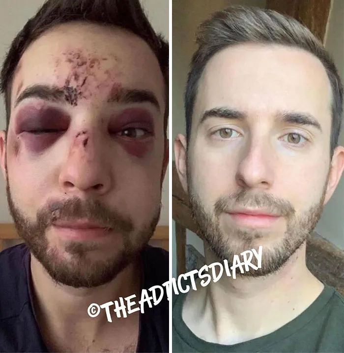 ‘The Addict's Diary' Showcases Before & After Transformations Of People Who Quit Drugs (30 Stories)