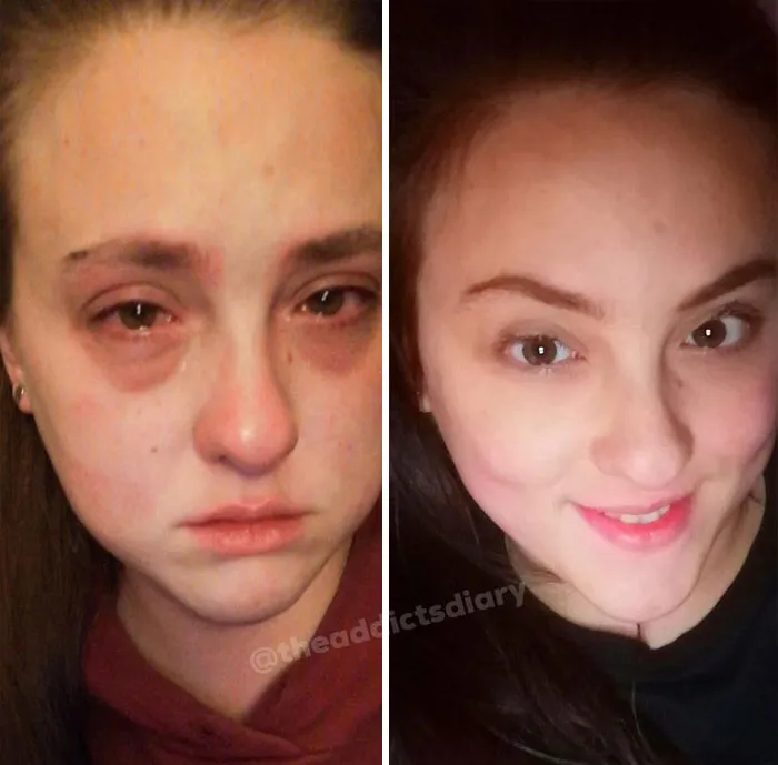 ‘The Addict's Diary' Showcases Before & After Transformations Of People Who Quit Drugs (30 Stories)