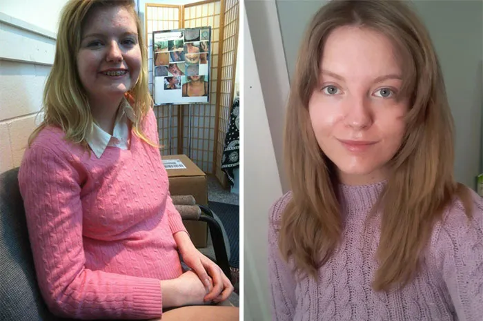 Still Working On Myself, But Time And Hygiene Can Do Wonders!  I Was Wearing Makeup In The First Pic, And Not The Second. [15/2012 - 24/2021]