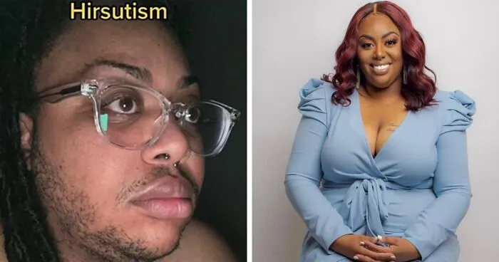 A TikToker Shares Her Experience With Hirsutism In Hopes Of Raising Awareness And Educating People On The Condition