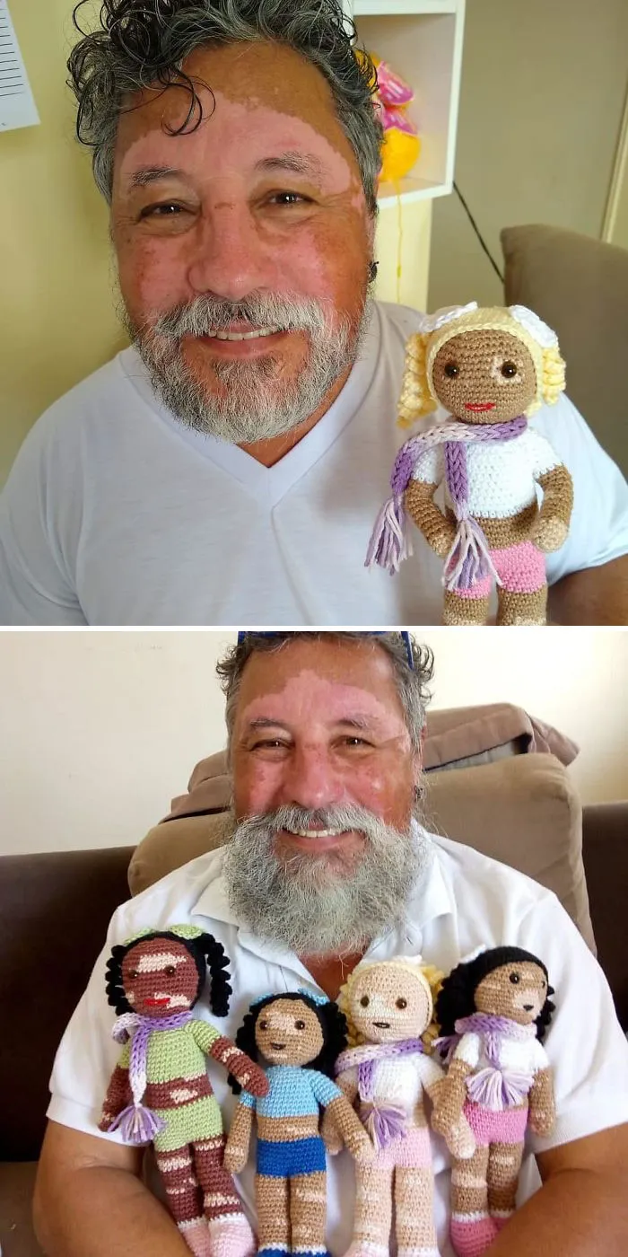 Un abuelo con vitíligo hace muñecos de ganchillo para que los niños con esta enfermedad se sientan mejor