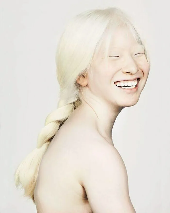 Abandoned As A Baby Due To Albinism, Xueli Grew Up To Become A Vogue Model (30 Pics)