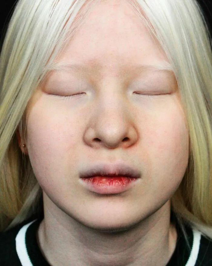 Abandoned As A Baby Due To Albinism, Xueli Grew Up To Become A Vogue Model (30 Pics)