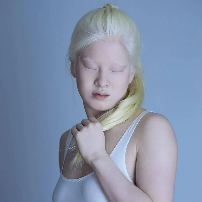 Abandoned As A Baby Due To Albinism, Xueli Grew Up To Become A Vogue Model (30 Pics)