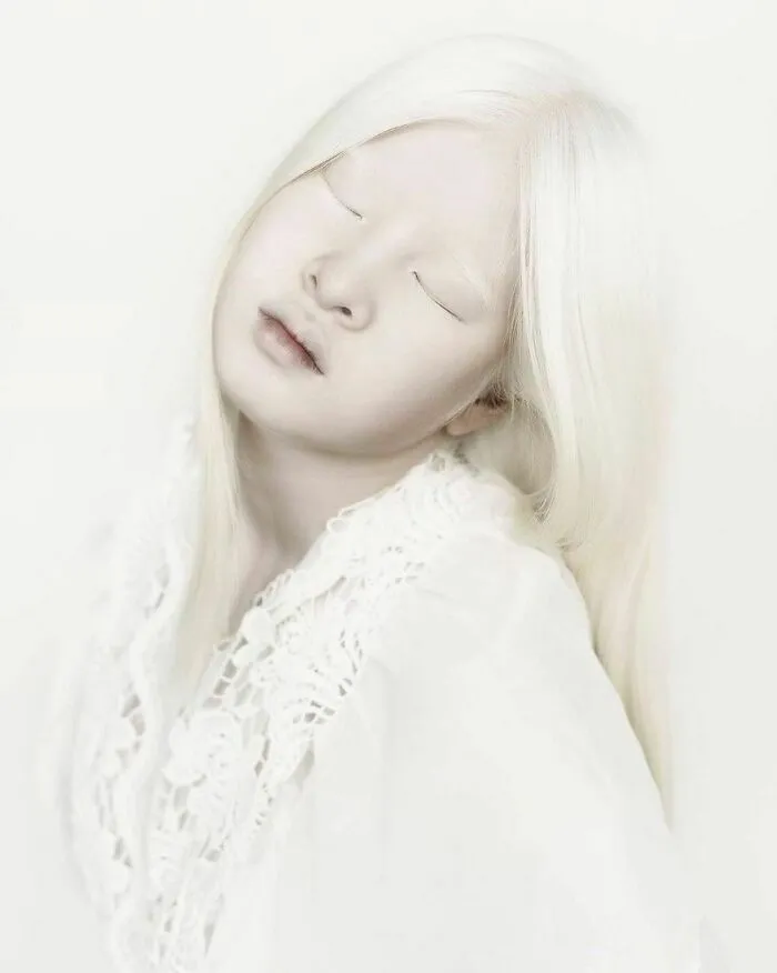 Abandoned As A Baby Due To Albinism, Xueli Grew Up To Become A Vogue Model (30 Pics)