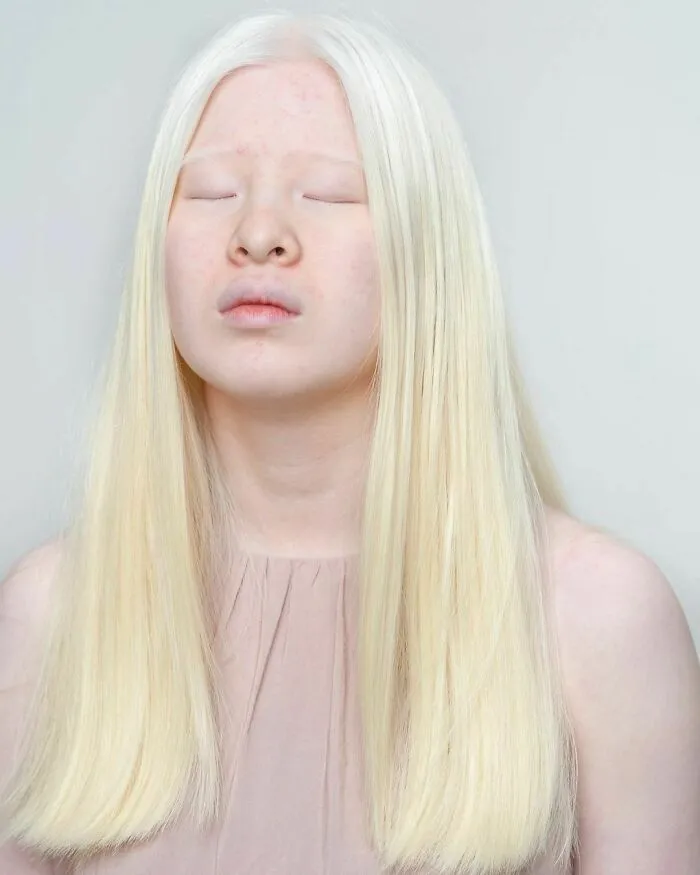 Abandoned As A Baby Due To Albinism, Xueli Grew Up To Become A Vogue Model (30 Pics)