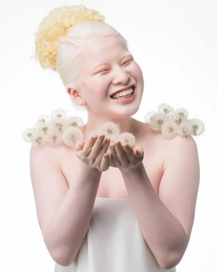 Abandoned As A Baby Due To Albinism, Xueli Grew Up To Become A Vogue Model (30 Pics)