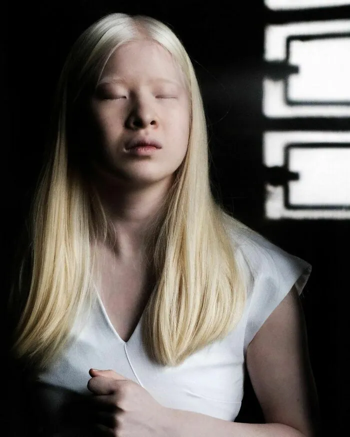 Abandoned As A Baby Due To Albinism, Xueli Grew Up To Become A Vogue Model (30 Pics)