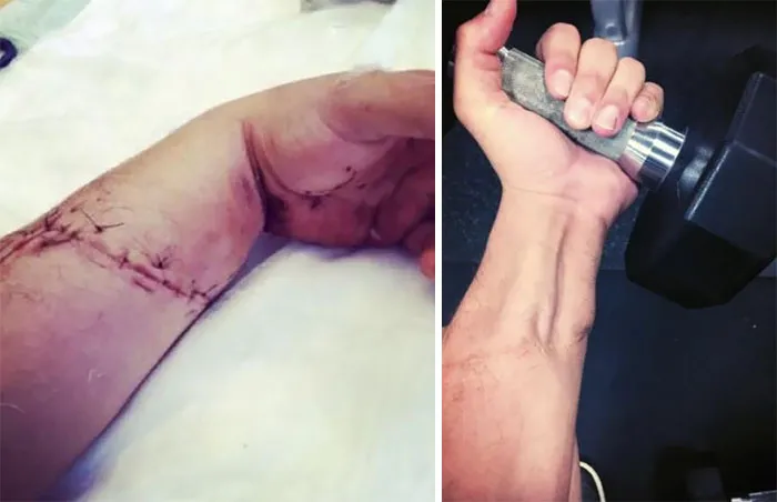 Never Thought I’d Be Able To Use My Hand Again. Shout Out To The Surgeon And Therapist