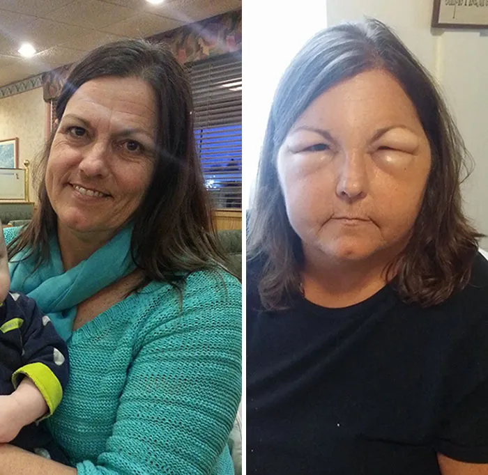 I Think My Mom Is Allergic To Hair Coloring
