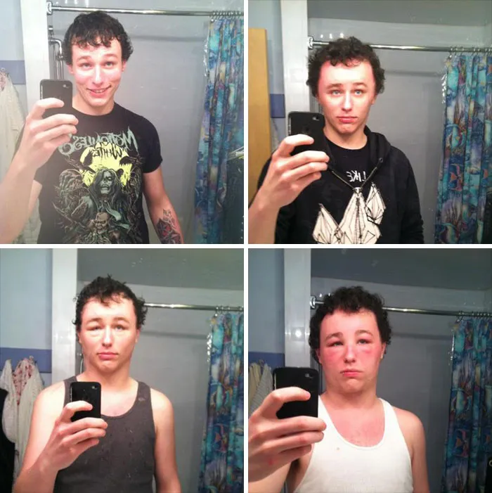 My Friend's Little Brother Had An Allergic Reaction To Hair Dye