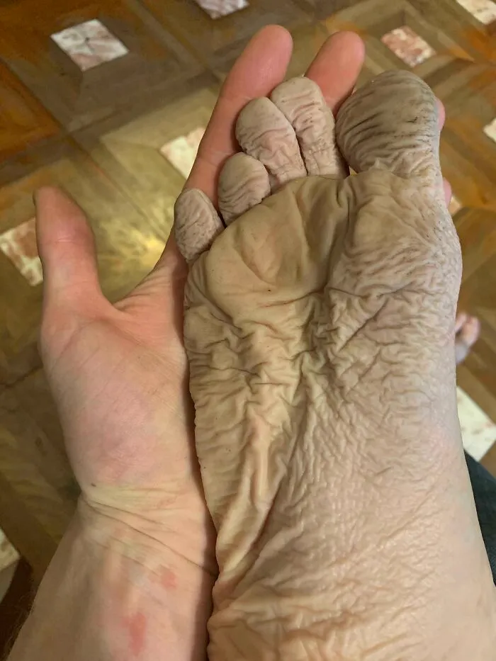 My Foot After Wearing A Wet Boot With A Hole In It For 10 Hours