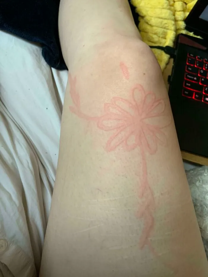 Tengo un trastorno de la piel llamado dermatografia, y hace que mi piel se hinche tras rascarme levemente. A veces me dibujo flores