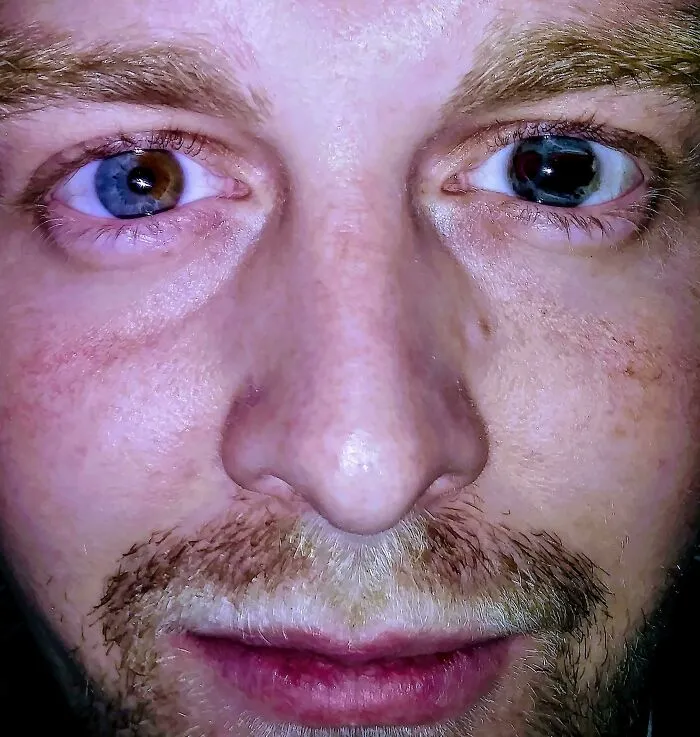 A Few People Have Actually Said Wtf When Looking At My Eyes