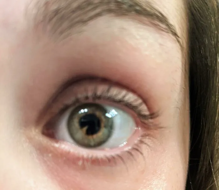 My Iris Is Misshaped But No Known Eye Problems After 25 Years