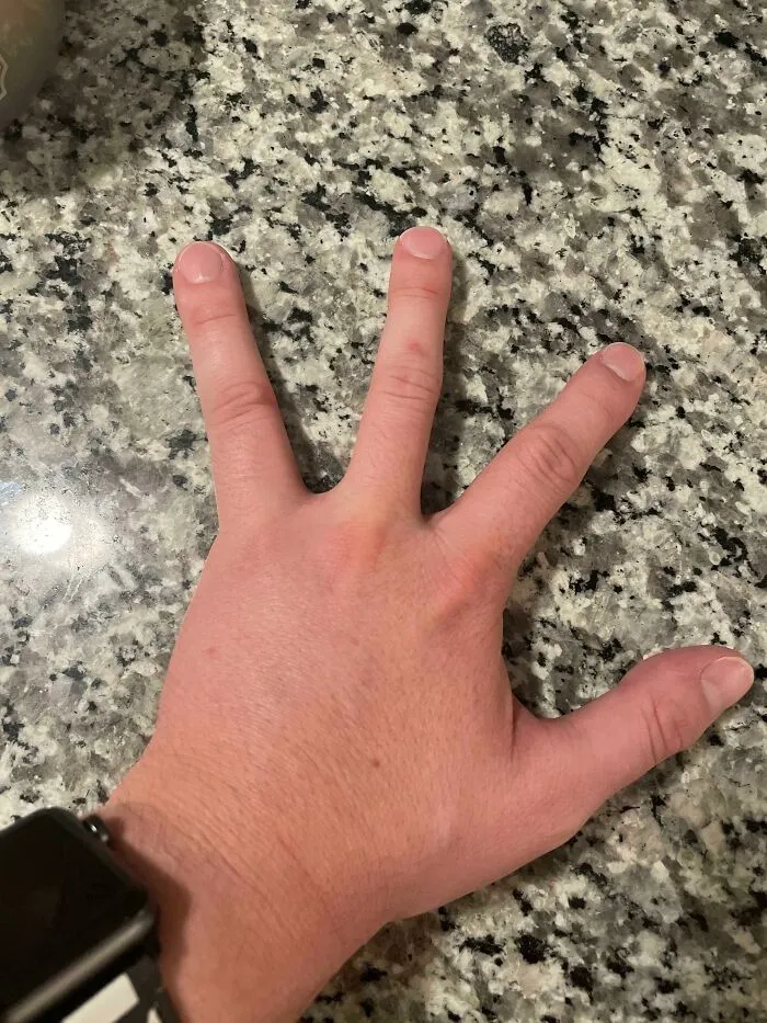 I Was Born With Only Four Fingers On My Left Hand