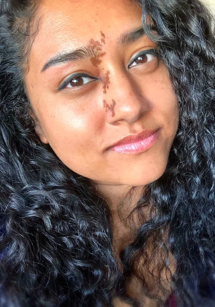 My Face Birthmark