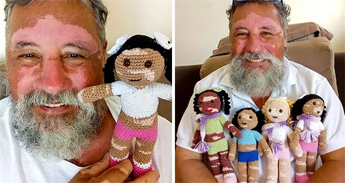 Grandfather With Vitiligo Crochets Dolls To Make Children With This Condition Feel Better