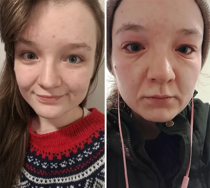 I Am Allergic To The Cold