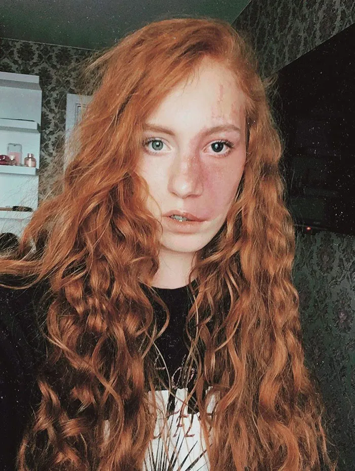 Her Birthmark Fits Perfectly With Heterochromia