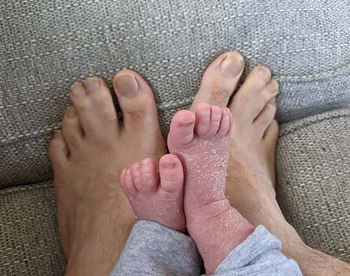 My Son Inherited My Joined Together Toes