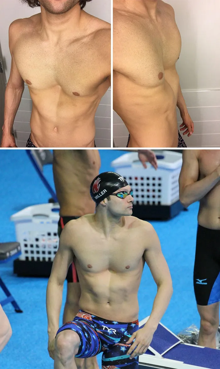 I Was Born With A Condition: Pectus Excavatum. Which I Know Sounds Like A Harry Potter Spell. My Deformity Began Appearing Around Age 10