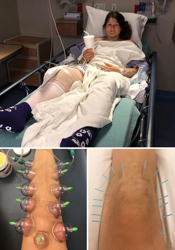 3 Weeks Ago I Finally Got My Knee Cleaned Up After Skiing In Pain For Years