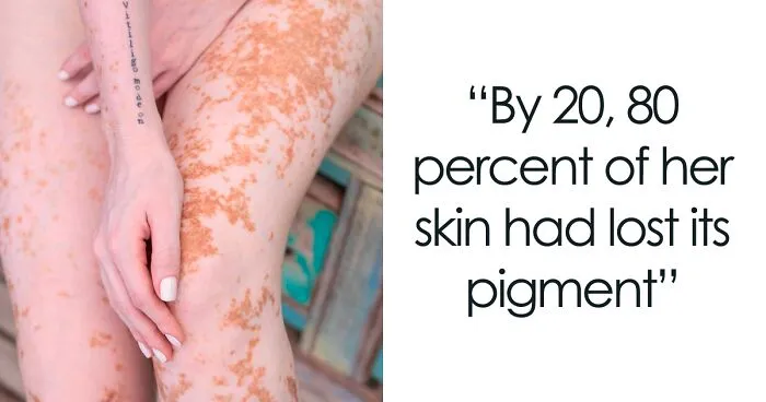 Woman With Vitiligo Overcomes Her Self-Confidence Issues After A Photoshoot With Famous Makeup Artist