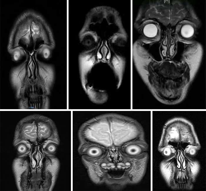 I Have Seen Your X-Ray Posts So I Bring You Face Mris