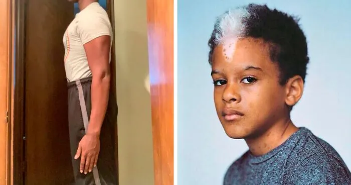 50 Photos Of Unique People's Features Because Of Their Rare Genetics (New Pics)