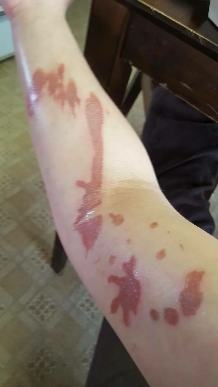 My Dumbest Injury, I Was Flipping A Steak In A Curved Pan, Like Flat Bottom Wok, And All The Butter Splashed Out