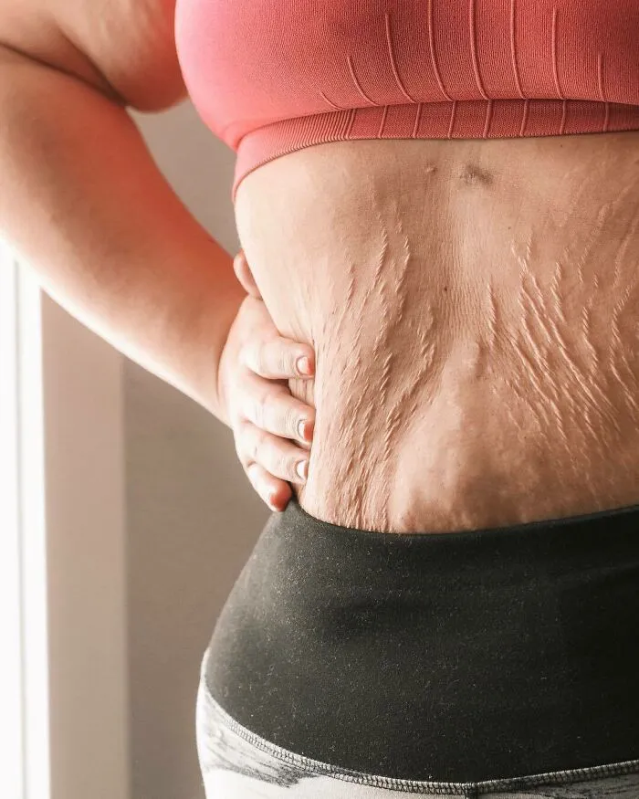 20 Fotos honestas de cuerpos postparto compartidas para mostrar la verdad de la que apenas se habla (nuevas fotos)
