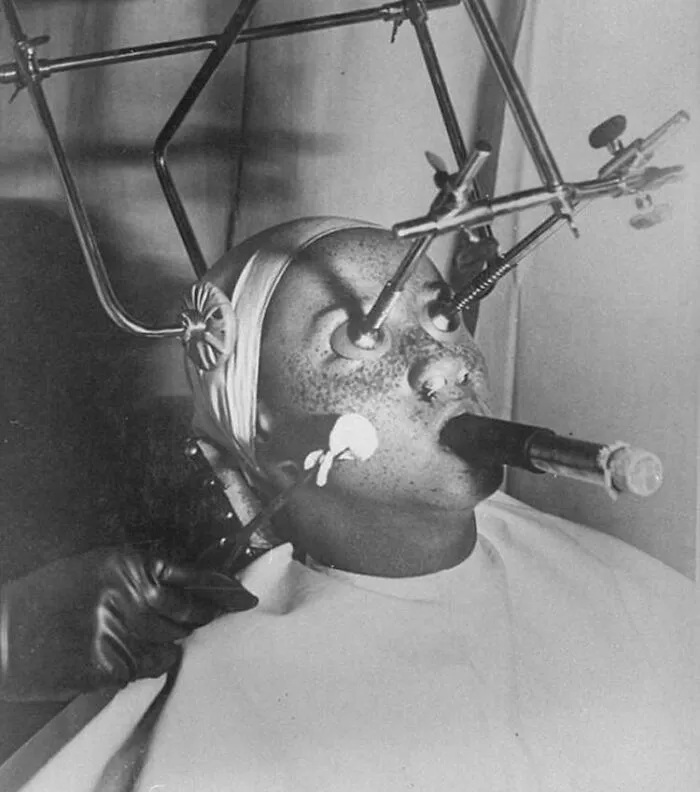 Freezing Off Freckles Procedure In 1930s