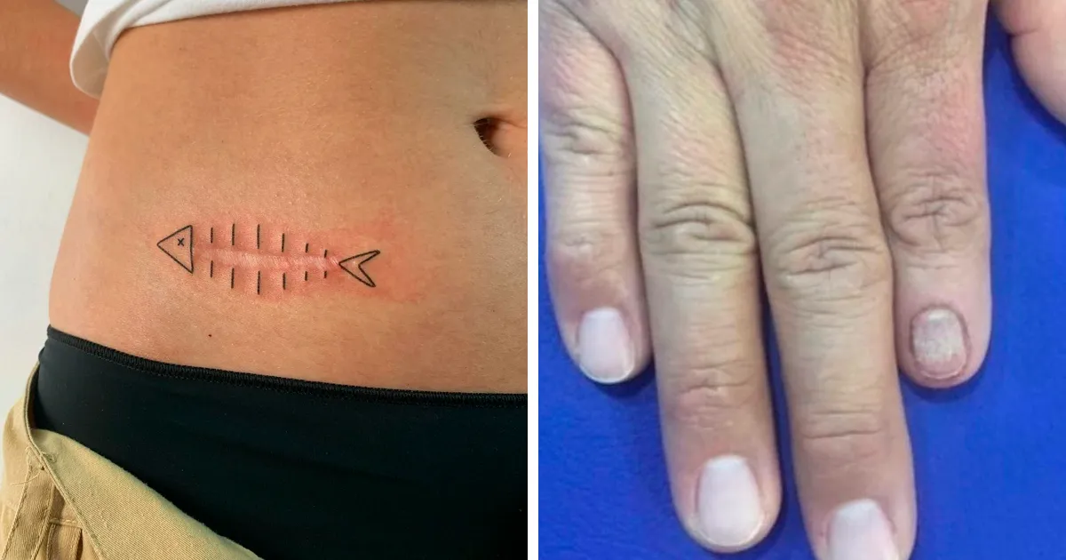 40 Personas que pidieron a tatuadores que cubrieran sus cicatrices y marcas de nacimiento y no pudieron estar más contentos con el resultado