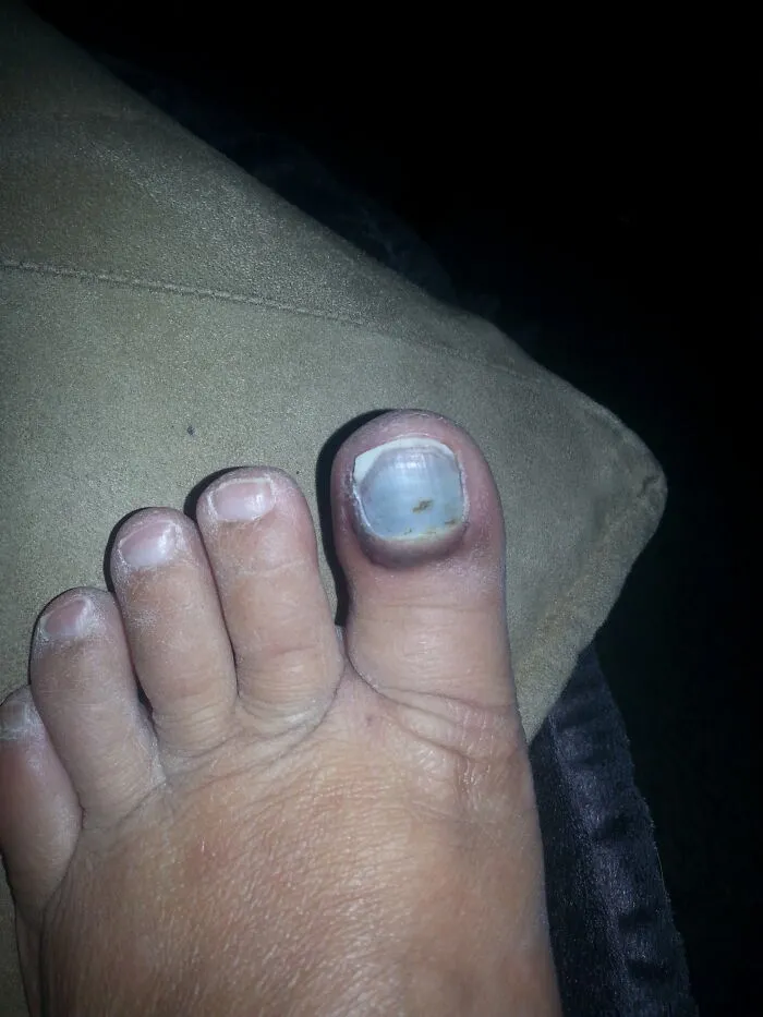 Dropped A Baking Sheet Edge First On My Toe, Turned This Pastel Blue Before Finally Turning Black And Falling Off....
