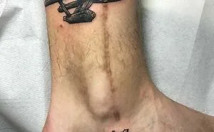 50 Times People Asked Tattoo Artists To Cover Up Their Scars And Birthmarks And Couldn't Be Happier With The Result