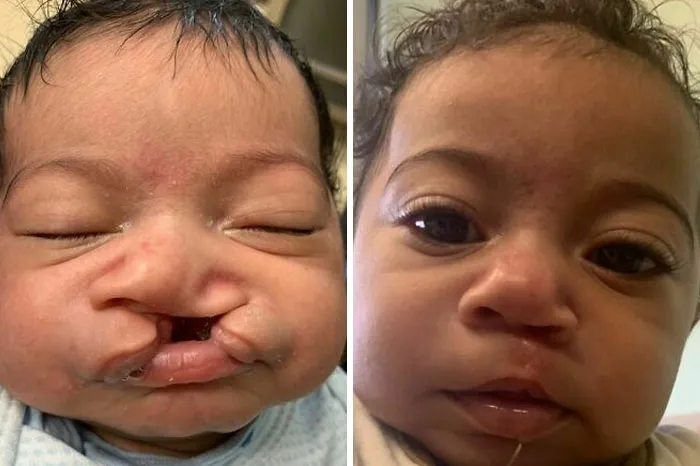 Before And After Cleft Lip Surgery