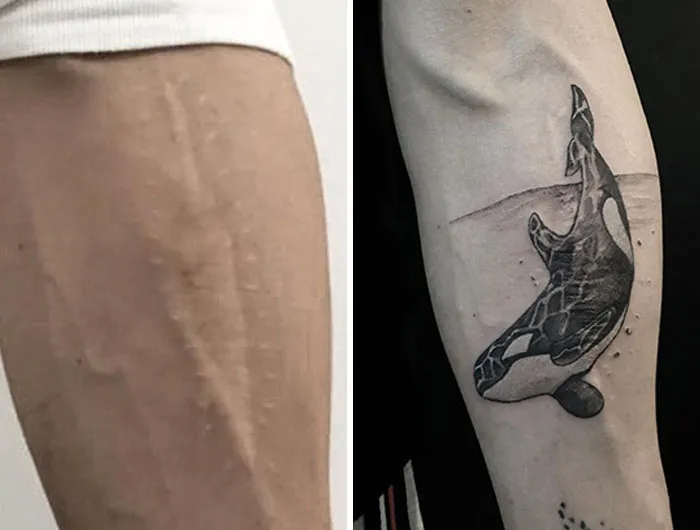 Tattoo covers scar with an orca design, showcasing transformative scar cover-up artistry.