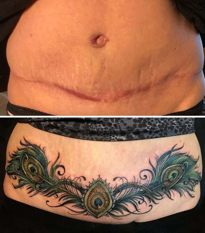 Tattoo covering scars with peacock feather design, showcasing transformative body art results.