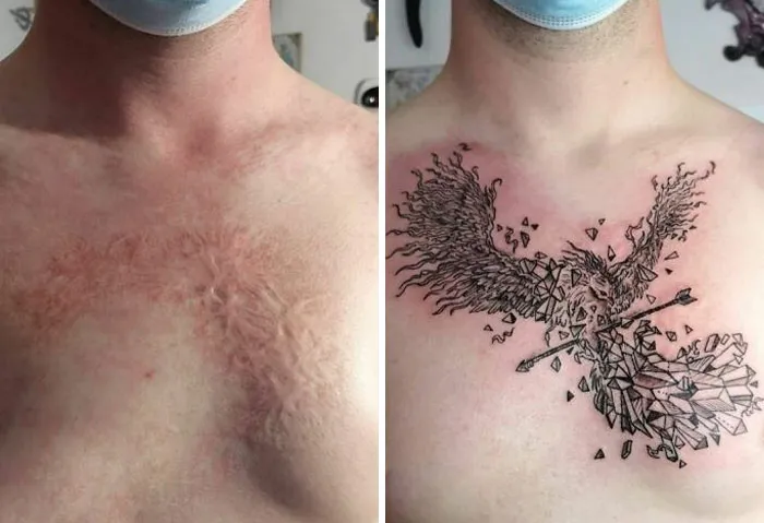 A Camouflage Of Childhood Domestic Burn