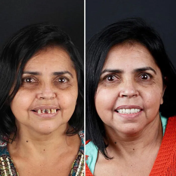 Brazilian Dentist Travels To Treat The Teeth Of Poor People For Free And Here Are 30 Transformations