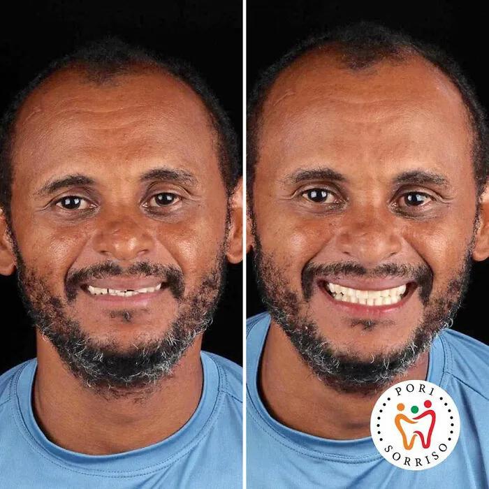 Brazilian Dentist Travels To Treat The Teeth Of Poor People For Free And Here Are 30 Transformations