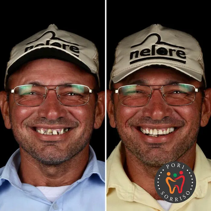 Brazilian Dentist Travels To Treat The Teeth Of Poor People For Free And Here Are 30 Transformations