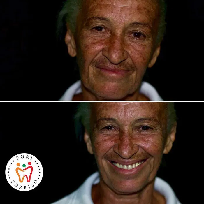 Brazilian Dentist Travels To Treat The Teeth Of Poor People For Free And Here Are 30 Transformations