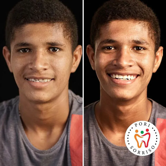 Brazilian Dentist Travels To Treat The Teeth Of Poor People For Free And Here Are 30 Transformations