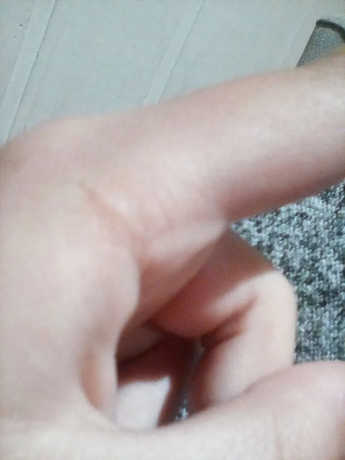 Hey Pandas, What Is The Weirdest Scar You Have And How Did You Get It? (Closed)