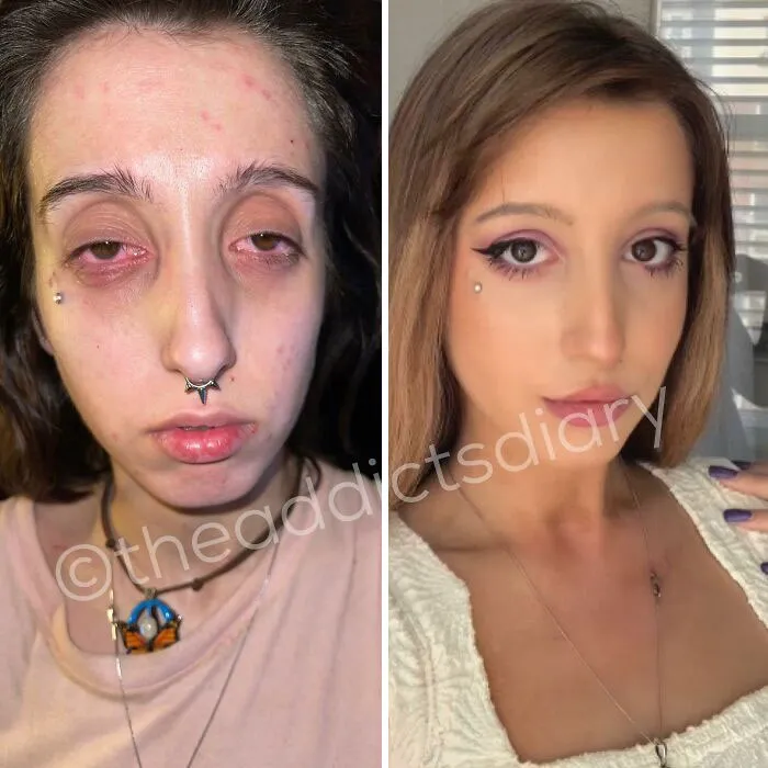 “Diario de un adicto”: 20 impactantes transformaciones de gente que solía ser adicta a las drogas (Nuevas historias)