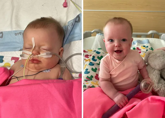 Antes y después: Mi hija luchando contra una combinación de VSR, Rhino Enterovirus y neumonía bacteriana. Casi murió, pero ahora está en casa sana y salva
