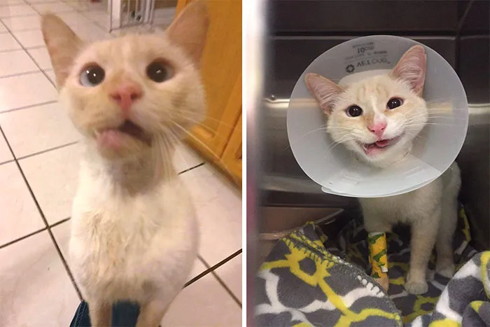 Before And After Jaw Surgery