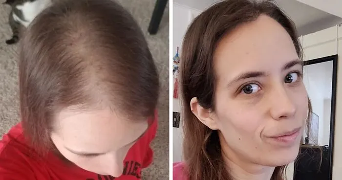 People Who Tried Out Hair Loss Treatments Are Sharing Their Results In This Dedicated Online Community (30 Pics)